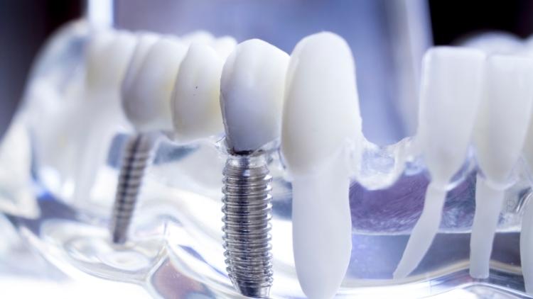 full ağız implant tedavileri full ağız implant tedavileri